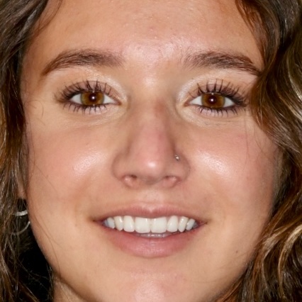 The same patient's smile after treatment
