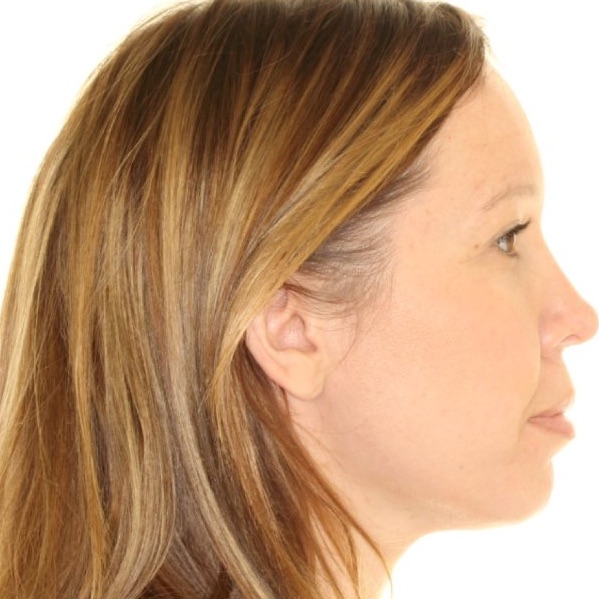 Adult patient's side profile before lingual braces