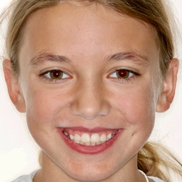The same child's smile after Phase 1 early treatment