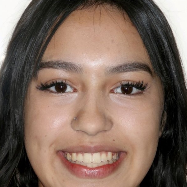 The same teen's straight smile after treatment
