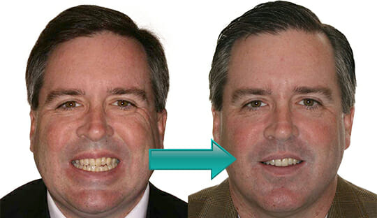 Gallery of Smiles - Orthodontists Before and After at Miller